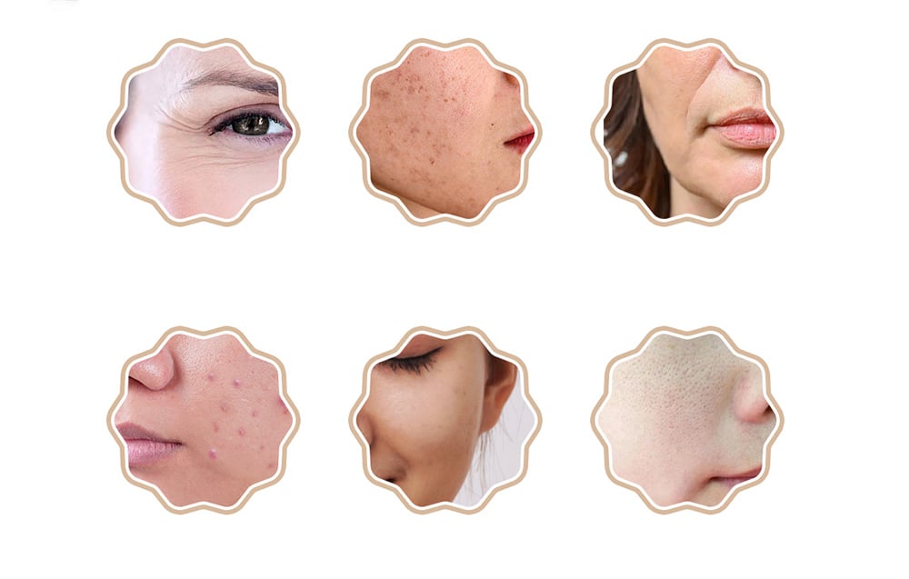 Six images rondes montrant différents problèmes de peau et leur amélioration